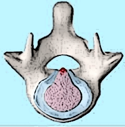 annular-tearadjusted
